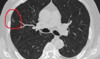 十个肺结节九个是癌